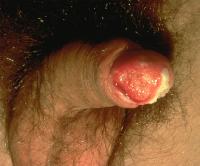 Squamous Cell Carcinoma Treatment India Clip Image003