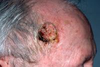 Squamous Cell Carcinoma Treatment India Clip Image005