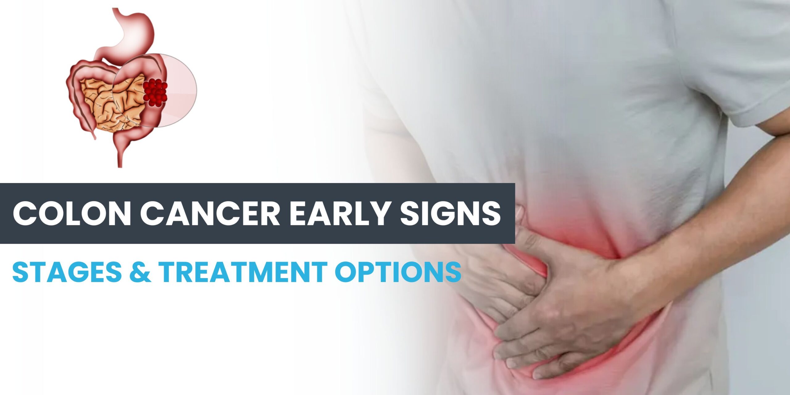 Illustration of colon cancer symptoms, stages, and treatments