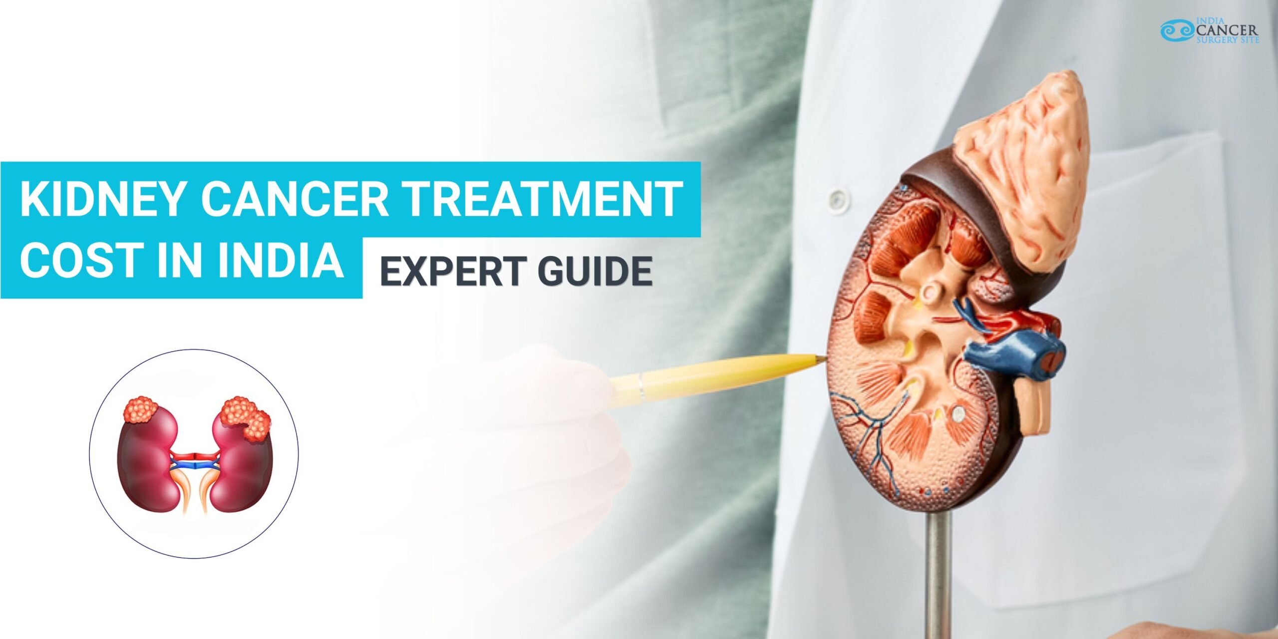Diagram of kidney cancer highlighting renal tumor location