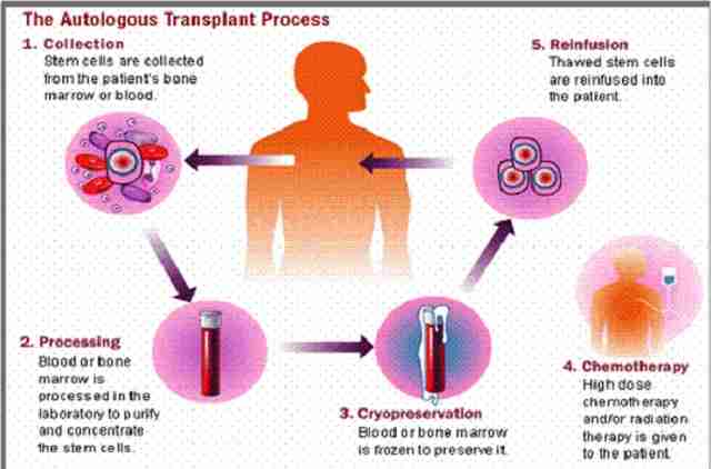 Autologous হাড় ম্যারো ট্রান্সপ্লান্ট