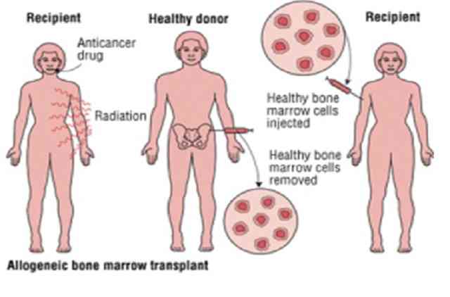 زرع النخاع العظمي Haploidentical