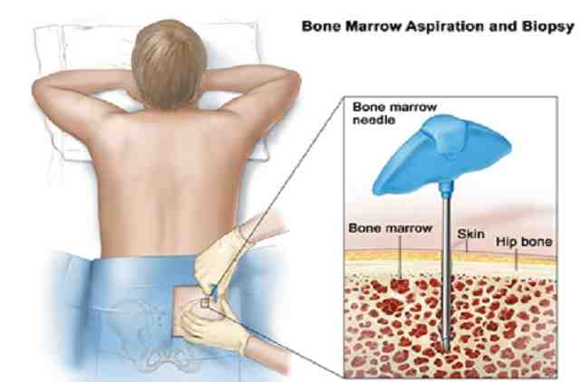 Syngeneic Bone Marrow Transplant