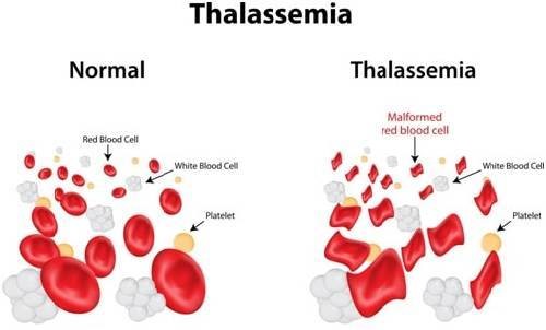 traitement de la thalassémie
