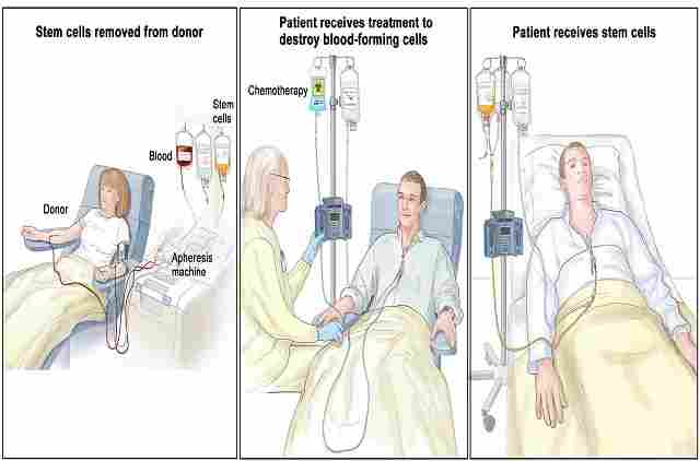 Regional Chemotherapy