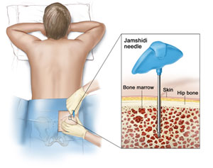 Acute Lymphoblastic Leukemia