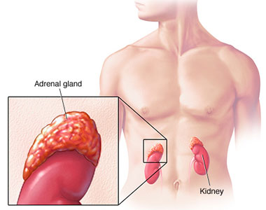 Adrenocortical Carcinoma