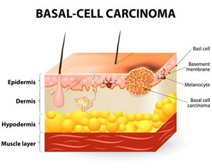 Basal Cell Carcinoma