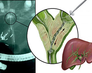 Bile Duct Treatment