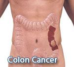 Colon Cancer