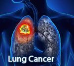 Lung Cancer