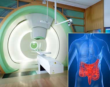 Rectal Cancer মলদ্বারে ক্যান্সার