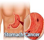 Stomach Cancer