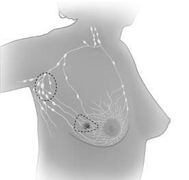 treatment breast cancer india clip